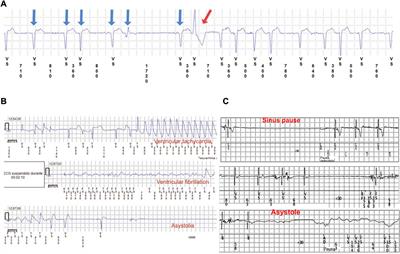 Characterization of cardiac involvement in children with LMNA-related muscular dystrophy